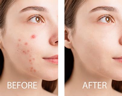 Before and after image showing the effect of the Spot Healing Brush