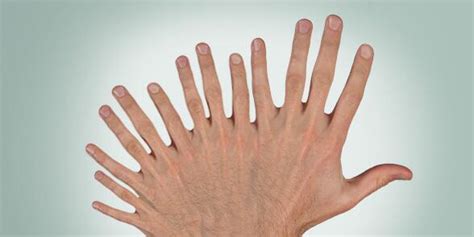 Illustration of a person with too many fingers on one hand