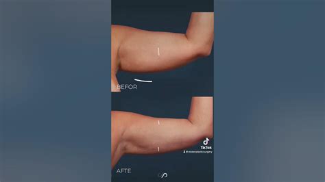 A split image showing a model's arm before and after applying glowing edge filters and adjustments.